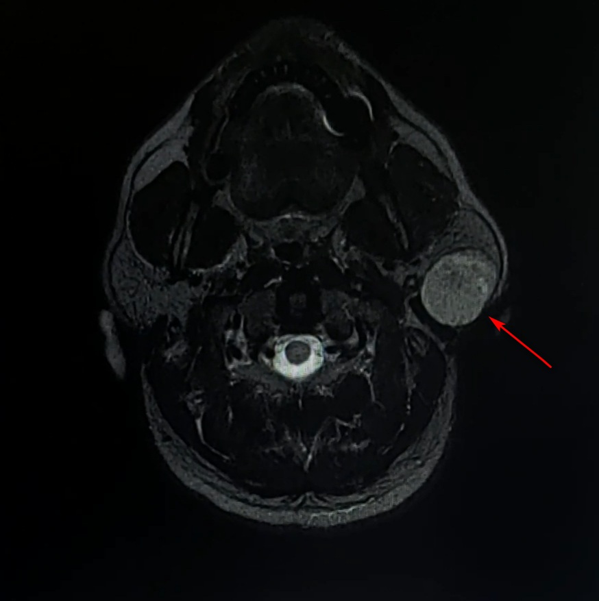 Fig 1. Aspect axial RMN. Se poate observa, fiind marcata de sageata, formatiunea tumorala rotunda, de dimensiuni impresionante si bine-delimitata in glanda parotida.