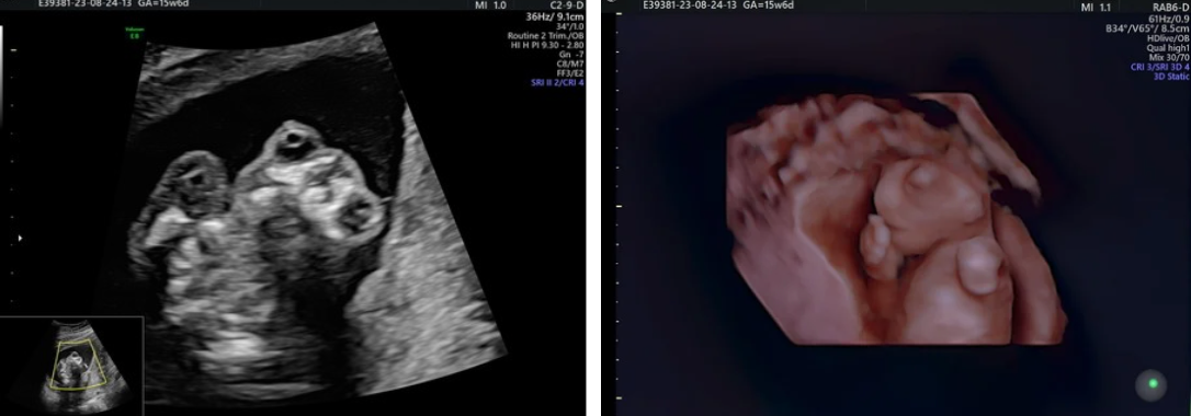 Imagine 2D (stânga) și 3D (dreapta) cu anencefalie la unul din cei 2 feți