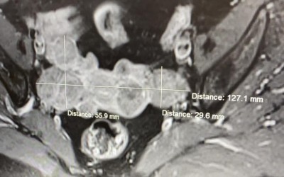 OBSTETRICA-GINECOLOGIE, pacienta operata laparoscopic pentru fibroame uterine: „Atata rabdare si calm cat am vazut la Spitalul Pelican, nu am mai vazut nicaieri!”