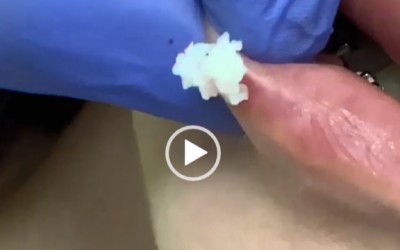 CHIRURGIE PLASTICA SI ESTETICA: Complicatiile injectarilor cu acid hialuronic