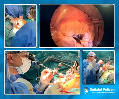 Acuratete superioara in plastia de valva mitrala realizata minim-invaziv, cu tehnologia video STORZ 4K