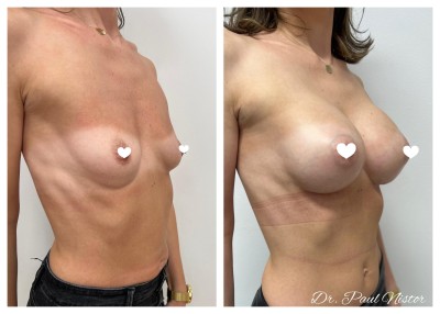 CHIRURGIE PLASTICA SI ESTETICA: augmentarea mamara, operatie cu impact emotional si personal