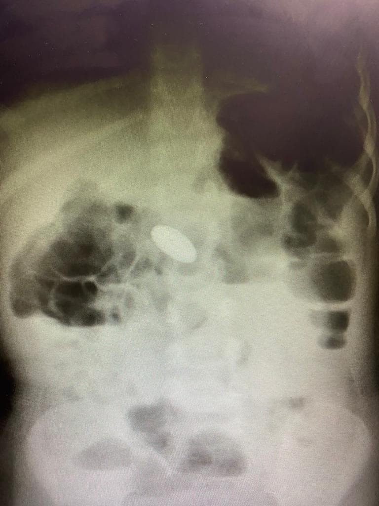 PEDIATRIE: Sa prevenim ingestia obiectelor!